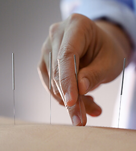 L’acupuncture Quelles sont les meilleures solutions pour arrêter de fumer sans grossir ? Laser o stop